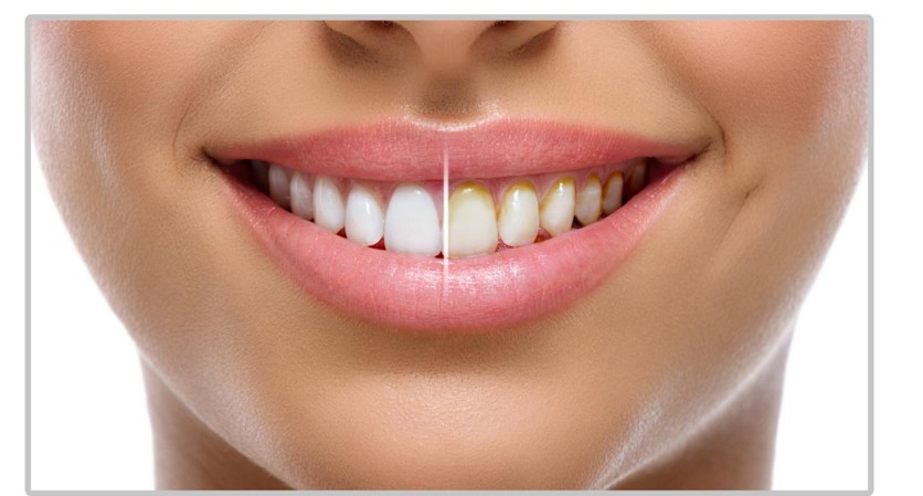 Miracle Smile Magic Flosser